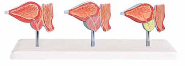 Normal and Diseased Prostate Gland